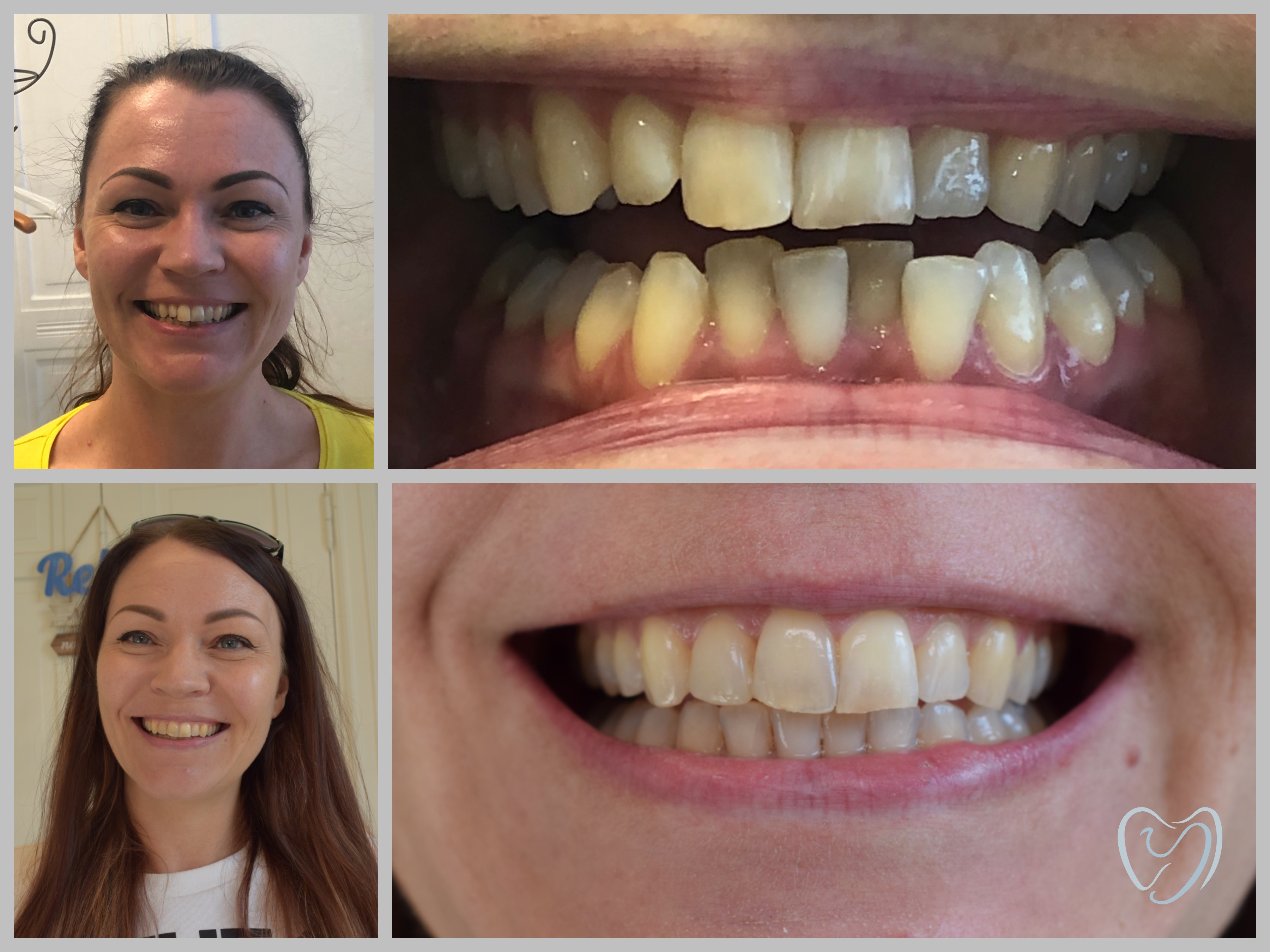 Invisalign