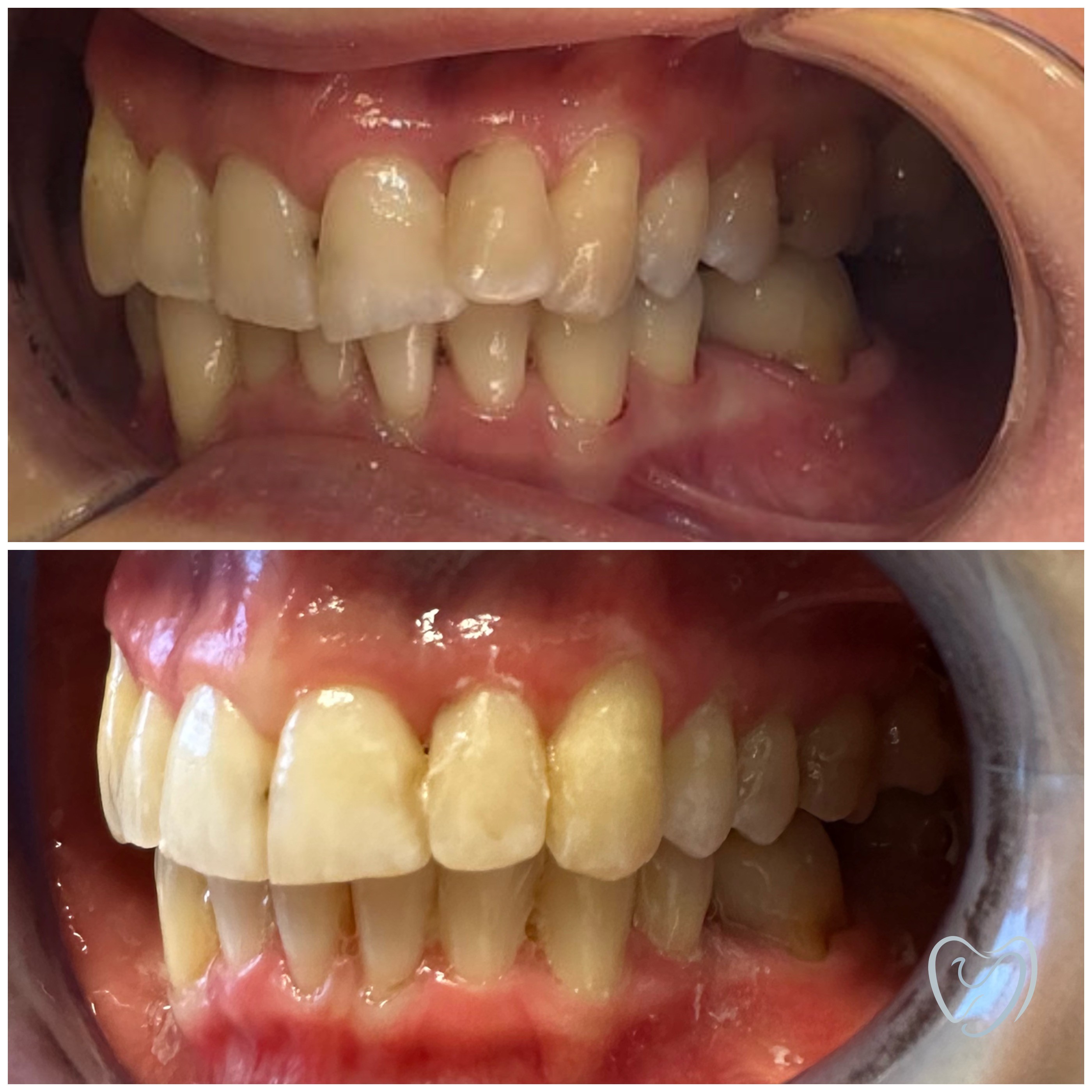 Invisalign3