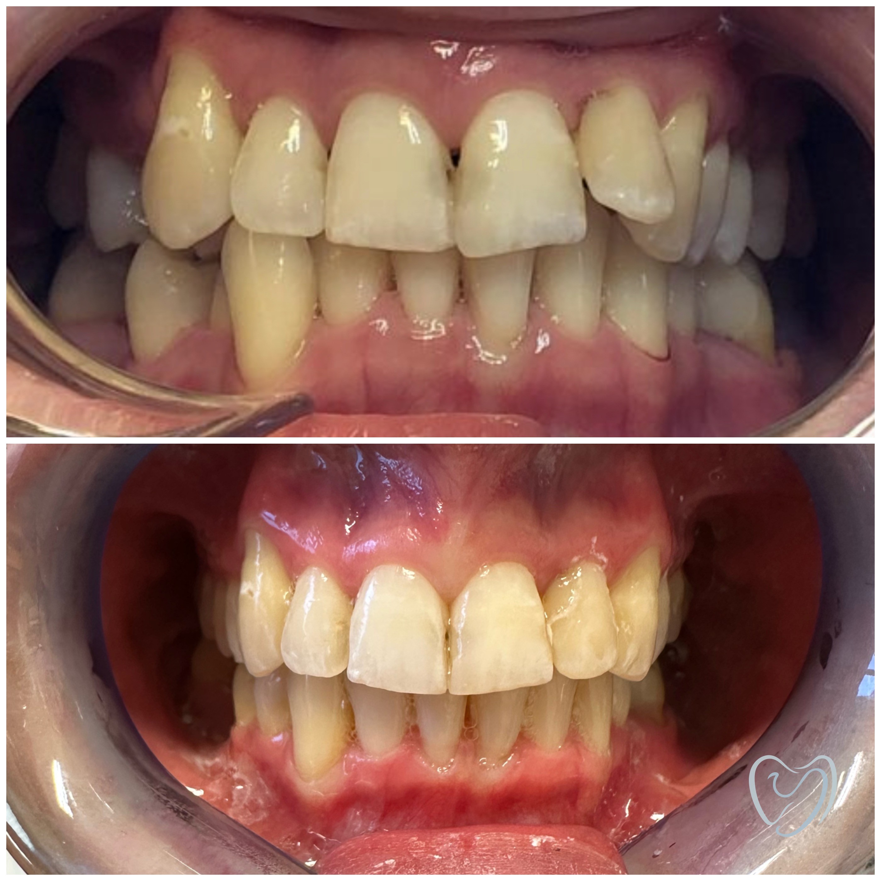 Invisalign4