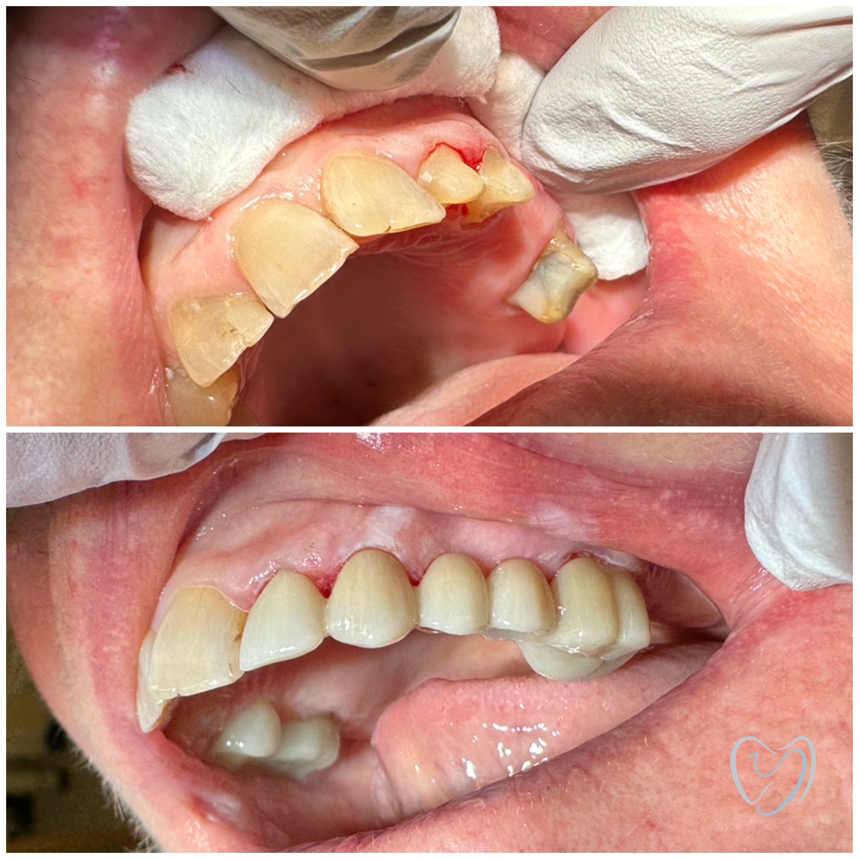 Invisalign6
